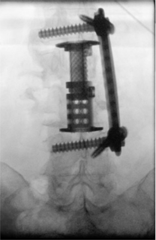 Intraoperative fluoroscopy depicting two pedicle screws posteriorly placed in a percutaneous fashion with a 5.5 × 100 mm2 rod placed in the pedicle tulips.