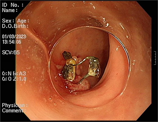 Foreign body penetrating the sigmoid wall with surrounding granulation tissue observed during colonoscopy.
