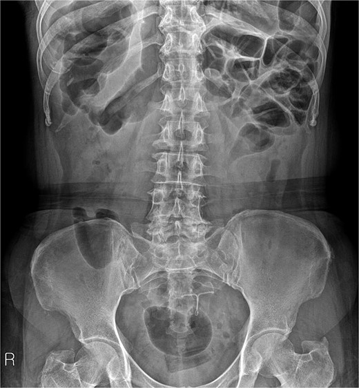 IUD identified on abdominal simple X-ray.