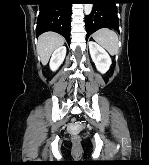 IUD positioning adjacent to the left uterus and extending into the colon, observed on CT.