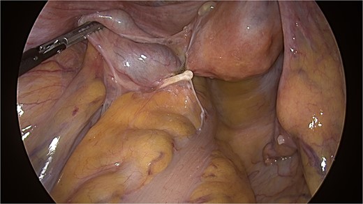 IUD with firm adhesions between the left adnexa and rectum observed during laparoscopy.