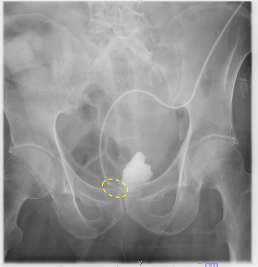 Persistence of fistula even after 2 months of re-operation (dotted circle)