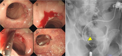 (a) Hyperplastic granulation tissue around the right side of the anastomosis. (b) Minor bleeding is observed after the gastrografin is injected through the drain. (c) A suspected fistula orifice site is closed provisionally using a MANTIS clip. (d, e) After provisional closure of the fistula orifice with a MANTIS clip, gastrografin is injected again through the drain, and no anastomotic leakage is observed (arrowhead). Subsequently, a definitive clipping is performed.