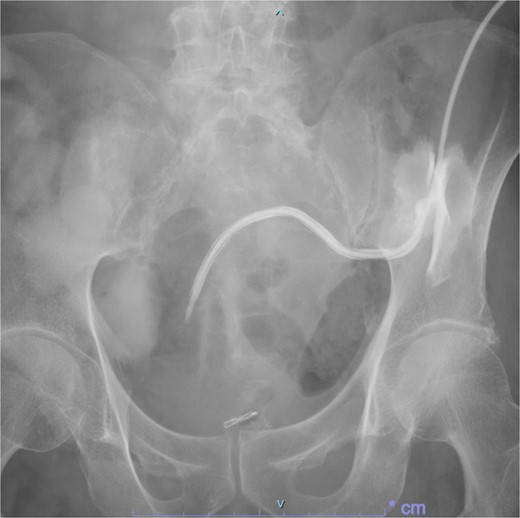 On day 15 after clipping, gastrografin injection under radiography reveals the fistula tends to recover.