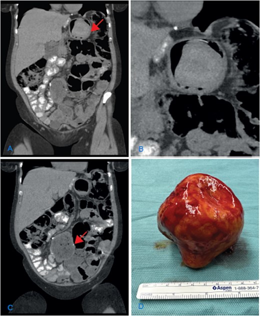 (A) Coronal CT scan image showing the dilatation of the gastric remnant with hypodensemass (arrow); (B) zoom of the gastric remnant with a 5-cm hypodense mass; (C) coronal CT scan image of the dilated JJ-anastomosis (arrow); (D) retrieved specimen a gallstone with approximately 10-cm diameter.