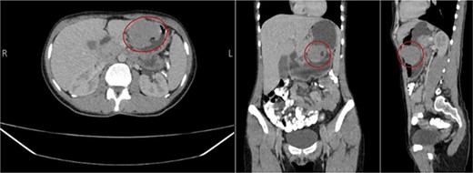 Well-defined enhancing oval-shaped gastric lesion seen in the gastric lesser curvature with intra and extra luminal components; it presents a small ulcer at the intraluminal component.