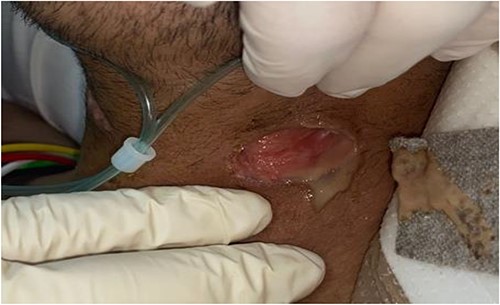 Clinical exam showing a left sided 3 × 3 cm wound with mild discharge.