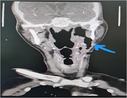 Contrasted neck CT showing fistula from the left peritonsillar area to antero-lateral aspect of the neck with a non-drainable subcutaneous fluid.