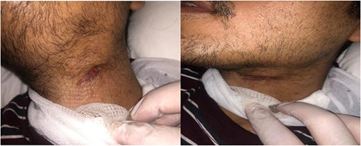 Clincal exam showing healed fistula and clean wound.