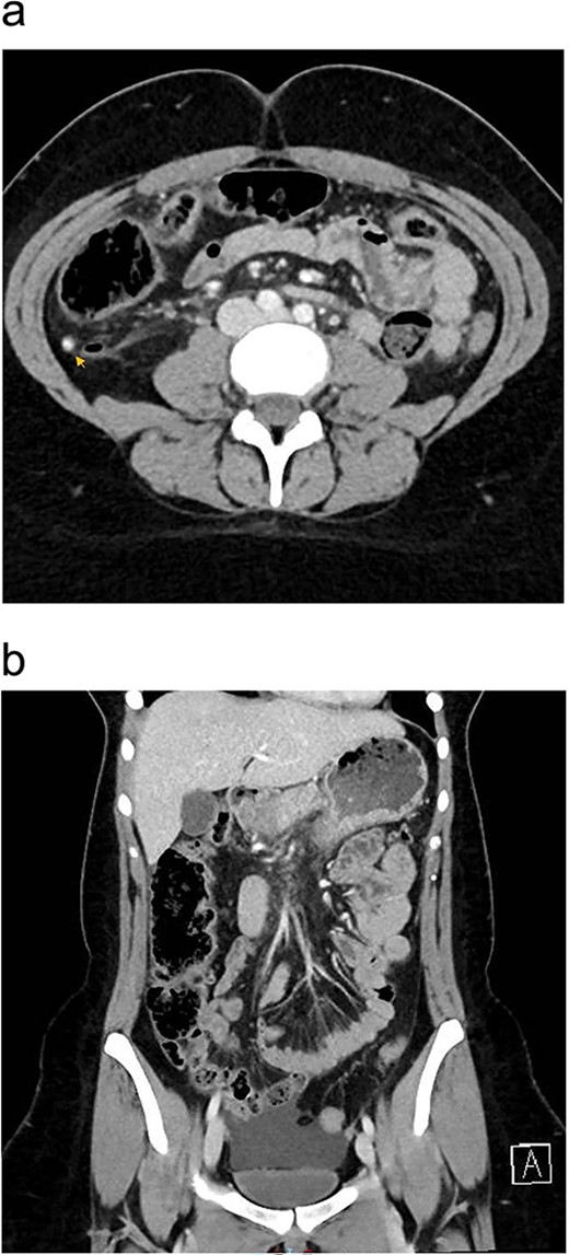 Preoperative enhanced CT abdomen and pelvis with axial (a) and coronal (b) views showing dilated appendix with hyperdense appendicolith within its lumen (arrow) associated with surrounding fat stranding and moderate amount of free fluid of −7 to 0.4 Hounsfield Units density.
