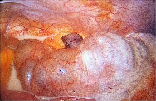 Laparoscopic view of the right lower quadrant showing chyloperitoneum with appendix tip in the middle (post ligation of appendicular artery).