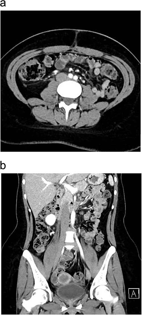One month postoperatively enhanced CT abdomen and pelvis with axial (a) and coronal (b) views showing resolution of inflammation and no signs of recurrence of chyloperitoneum.