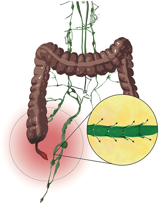 Illustritation of the hypothetical pathophysiology behind acute chyloperitoneum with appendicitis.