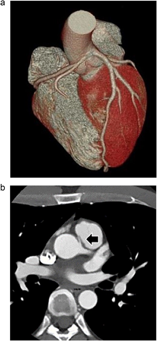 Preoperative three-dimensional CT, and enhanced CT shows AAORCA (a), and the right coronary artery (arrow) ran between the ascending aorta and the main pulmonary artery (b).