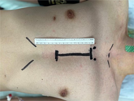 The surgery was performed under lower mini-sternotomy with a 10-cm skin incision.