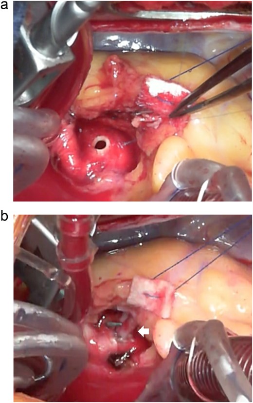The hole was punched through the aorta with a 3.5-mm aortic punch (a) and the right coronary artery (arrow) was carefully fixed to the ascending aorta with 8-0 polypropylene continuous suture (b).