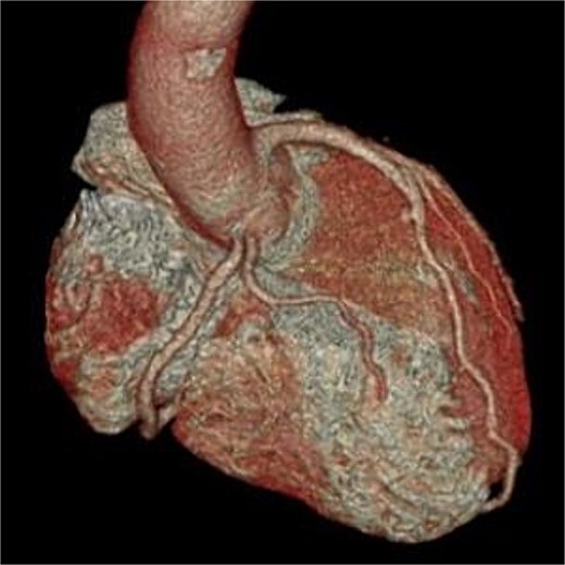 Postoperative three-dimensional CT, and enhanced CT shows the patency of the right coronary artery.