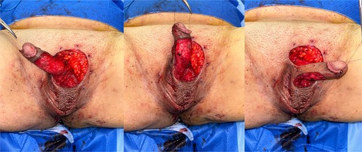 Near circumferential defect of the penile shaft skin following wide excision of EMPD.