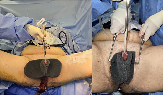 Application of double-opposing negative pressure dressing to splint the penile shaft.