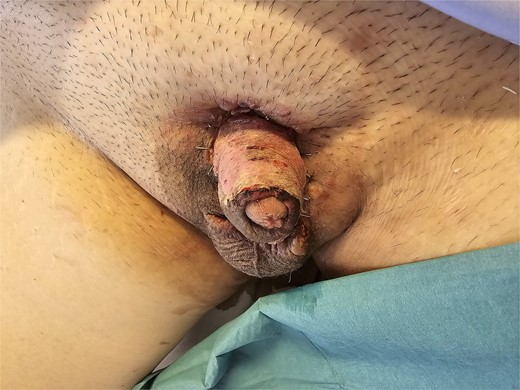 Good skin graft take and contour following 1 week of negative pressure dressing.