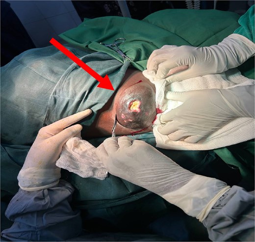 Beginning of surgery (WLE) at left axilla with ulcerated prominent ectopic breast tissue (indicated by an arrow).