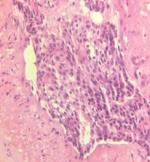 H&E stain slide shows histopathological features of IDC.