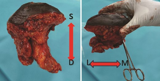 Gross finding appearance of the EBT specimen showed a solid mass with clear margins. S: superficial margin; D: deep margin; M: medial margin; L: lateral margin.