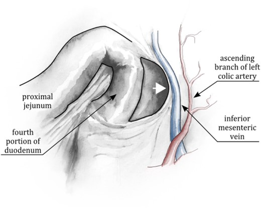 Left Paraduodenal Fossa, aka Landzert’s fossa. The fossa can be conceptualized as the recess formed by the tenting of the posterior peritoneum by the IMV, the ascending branch of the left colic artery, or both (as the positions of these vessels relative to one another are variable). This tenting creates a fold, or lip, behind which abdominal contents can herniate in a right-to-left fashion (arrow).