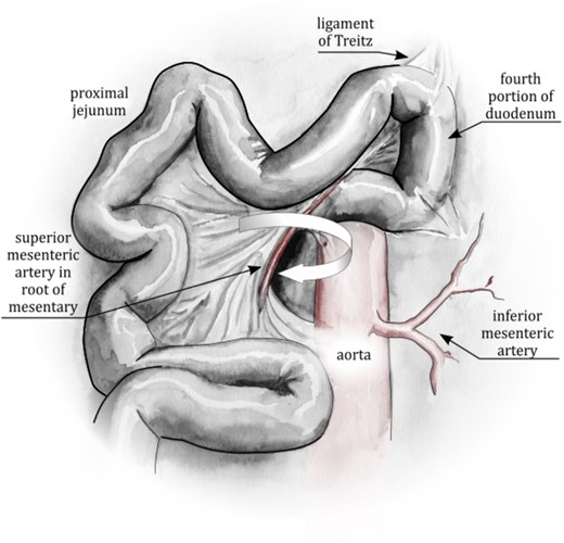 Right Paraduodenal Fossa, aka Waldeyer’s Fossa. The arrow represents the direction of rotation of the small bowel into the fossa. The arrow points into the fossa. The anterior/left edge of the fossa is formed by the tenting of the left mesenteric leaflet around the superior mesenteric vessels. The small bowel rotates around the superior mesenteric vessels to become entrapped behind the transverse mesocolon. This is effectively a partial reversal of mid-gut rotation, or, in some cases, a failure of complete rotation.