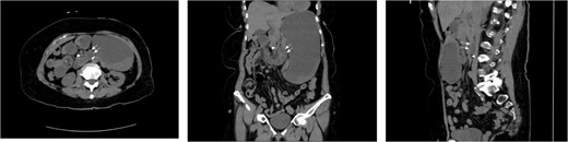 CT cross sectional images of Case 1, axial, coronal, and sagittal, respectively. Note the position of the dilated afferent small bowel (double arrow) posterior to the SMA (single arrowhead), thus confirming the retroperitoneal position of the entrapped bowel. Also note that while left paraduodenal hernias are typically described as existing in the left retroperitoneal position, there is no fixed midline barrier preventing their herniation to the across right of midline. In either case, the peritoneal defect, Landzert’s fossa, is the same with identical surrounding landmarks.