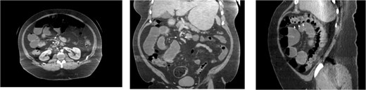 CT images for Case 2, axial, coronal, and sagittal, respectively. Note the mesenteric swirl (arrows in axial and coronal images) around the SMA (single arrowhead in axial and coronal images). This represents the posterior torsion of the small bowel mesentery as it courses into Waldeyer’s fossa toward the right retroperitoneum. The resulting dilated small bowel can be seen in the right upper quadrant. Also note the anterior course of the proximal transverse colon (three arrowheads in the sagittal cross-section) as it has been pushed toward the anterior abdomen due to the significant mass of dilated small bowel which is now posterior to its mesentery.