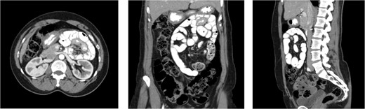 CT images for Case 3, axial, coronal, and sagittal, respectively. The isolation of the contrast-filled small bowel can be appreciated in the right upper quadrant, representing bowel entrapped within the left paraduodenal hernia.
