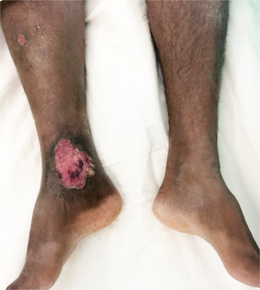 A neglected venous ulcer in the right gaiter area for 2 years.