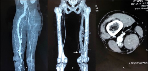 CT venogram (A) axial, (B) 3D reconstruction, (C) axial view at adductor cannel. There is early opacification of the popliteal vein in the arterial phase just below the level of adductor cannel on the right side and it is draining into inferior vena cava via the common femoral vein and iliac vein. The superficial venous system is not dilated. These features are consistent with high flow AVF most probably between the popliteal artery and vein.