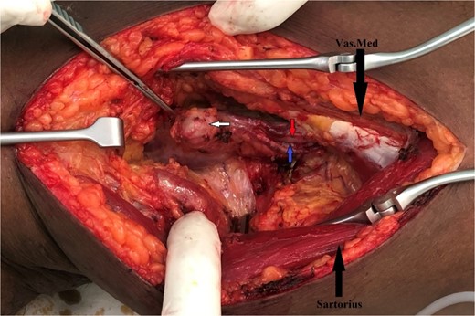 Intraoperative finding of AVF with aneurysm between popliteal artery and vein.