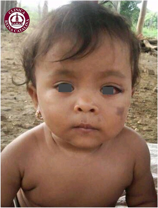 Photograph provided by the patient’s mother at 6 months of age, showing a hyperpigmented area on the left cheek and a mild deviation of the left nasal ala.