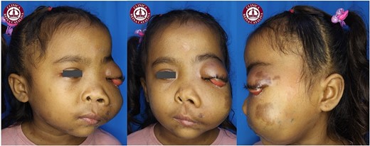 Photograph taken during the patient’s initial evaluation at our clinic at 6 years of age, revealing severe deformation of the left hemiface with significant involvement of the left cheek and upper eyelid.