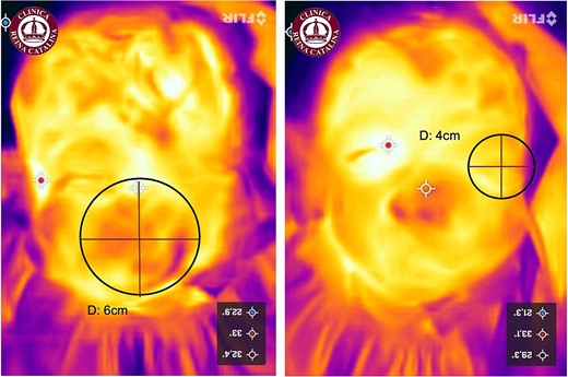 Thermographic image of the pediatric hemangioma highlighting the areas affected by the hemangioma. The blue regions indicate areas with lower temperatures. Left: Diameter of the left cheek hemangioma (6 cm). Right: Diameter of the upper eyelid hemangioma (4 cm). Note: Images were taken at the first encounter.