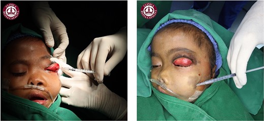 Intraoperative photograph showing the injection of the sclerosant (Ethamolin) into the left upper eyelid and left cheek.