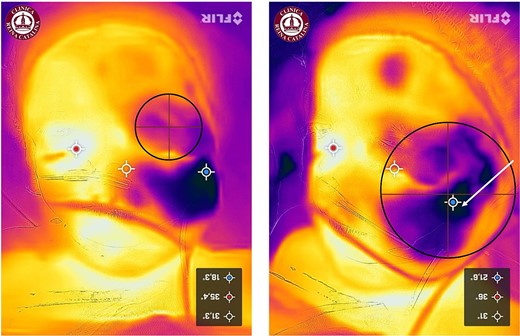 Thermographic monitoring of the pediatric hemangioma, showing marked areas indicating hemangioma lacunae prior to the placement of ice packs. Left: upper eyelid; Right: left cheek. The white arrow highlights the center and the largest affected area. Note: Images taken before the initiation of sclerotherapy.