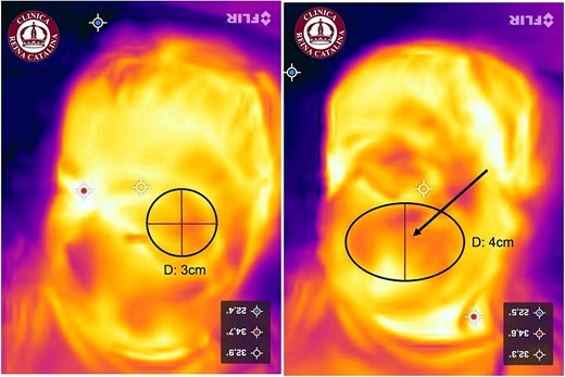 Thermographic monitoring of the pediatric hemangioma after six sclerotherapy sessions, demonstrating a reduction in the diameter of the lacunae. Left: upper eyelid, showing a 1-cm reduction in diameter. Right: left cheek, showing a 2-cm reduction in vertical diameter while maintaining the transverse diameter, transitioning from a round to an ovoid shape.