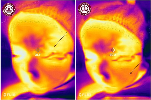 Thermographic monitoring of the pediatric hemangioma following eight sessions of sclerotherapy, showing decreased cold uptake and retention in both the upper eyelid and left cheek regions.