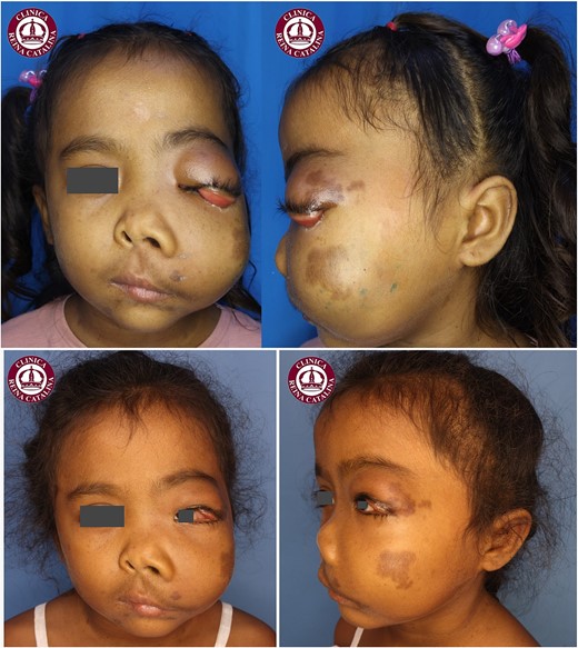 Photographic comparison of the patient. Upper: frontal and lateral views at the initial consultation. Lower: frontal and lateral views after eight sessions of sclerotherapy, illustrating significant improvement in the hemangioma, particularly in the left upper eyelid with increased ocular opening and improved vision, along with minimal but clinically significant reduction of the zygomatic lesion.