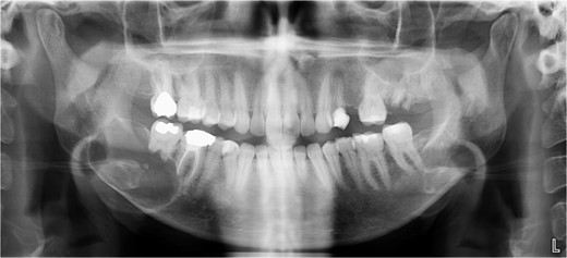 Panoramic radiograph showing a unilocular radiolucency extending from the right mandibular angle to the right first molar region.