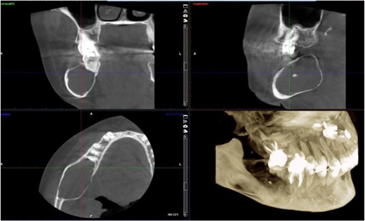 Panoramic radiograph highlighting the extent of the lesion from the mandibular angle to tooth #46.