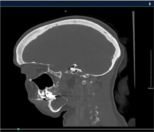 Intraoperative view of the surgical site showing the resection area and preservation of the submandibular gland and marginal mandibular branch of the facial nerve.