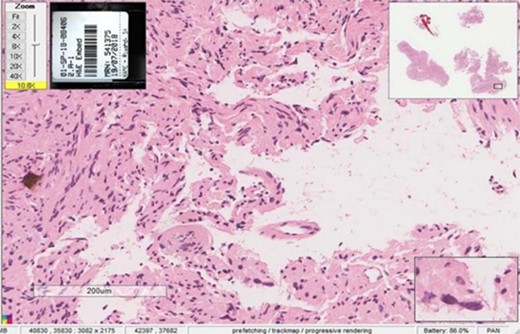 Histopathological examination showing Antoni A and Antoni B patterns with hyalinized Verocay bodies among spindle-shaped cells.