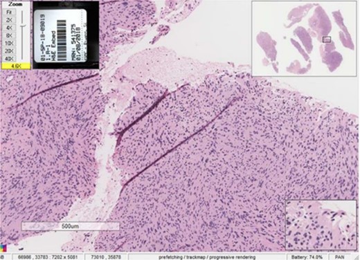 Close-up view of the histopathological slide confirming the diagnosis of schwannoma.