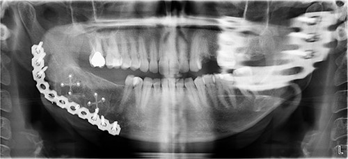 Postoperative panoramic radiograph demonstrating the reconstruction plate in place after tumor resection and bone grafting.
