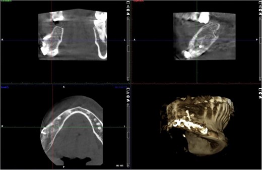 Follow-up panoramic radiograph showing stable reconstruction plate and no signs of recurrence one year postoperatively.